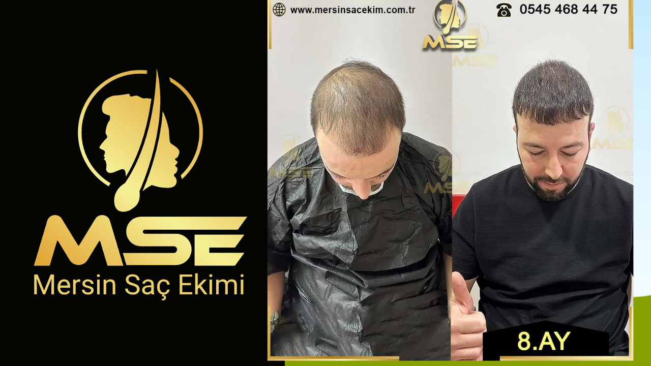 MERSİN SAÇ EKİMİ